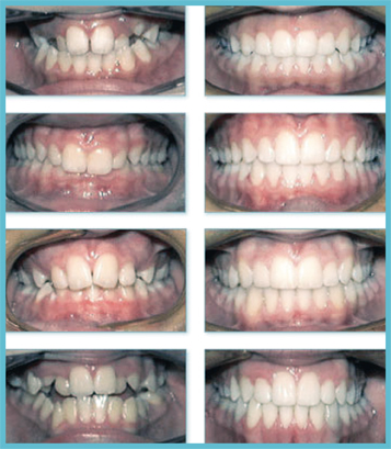 gouttières transparentes invisalign - cabinet orthondontie - paris