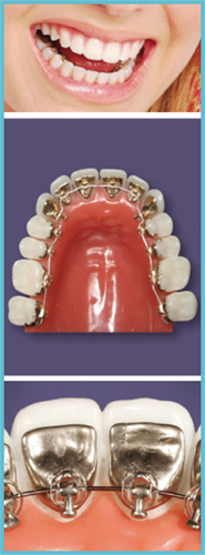 orthodontie linguale incognito paris