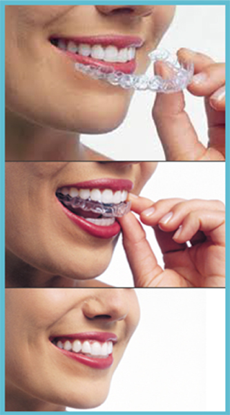 gouttière invisalign : gouttière orthodontie transparente